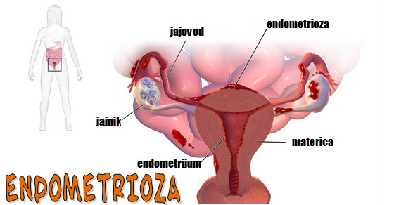 endometrioza simptomi i lečenje